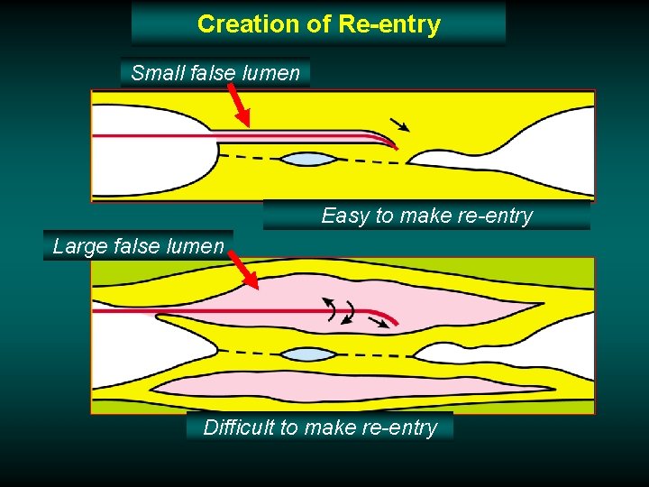 Creation of Re-entry Small false lumen True lumen Easy to make re-entry Large false Creation of Re-entry Small false lumen True lumen Easy to make re-entry Large false