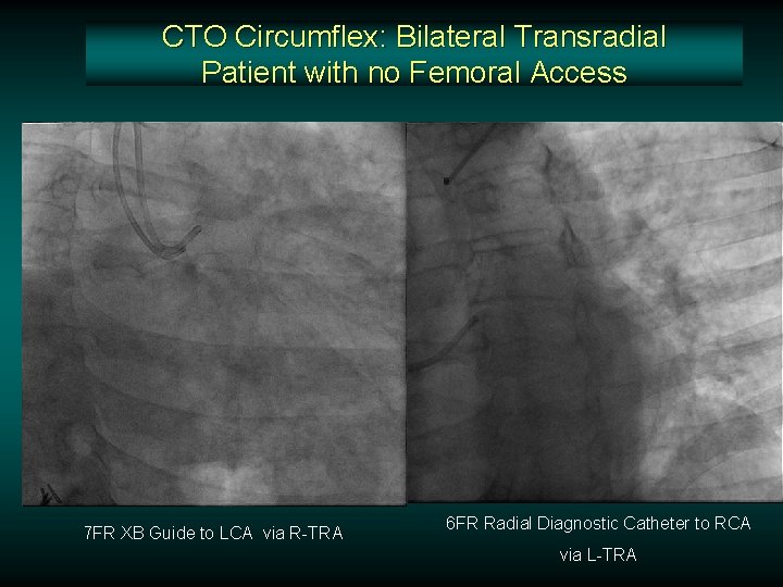 CTO Circumflex: Bilateral Transradial Patient with no Femoral Access 7 FR XB Guide to CTO Circumflex: Bilateral Transradial Patient with no Femoral Access 7 FR XB Guide to