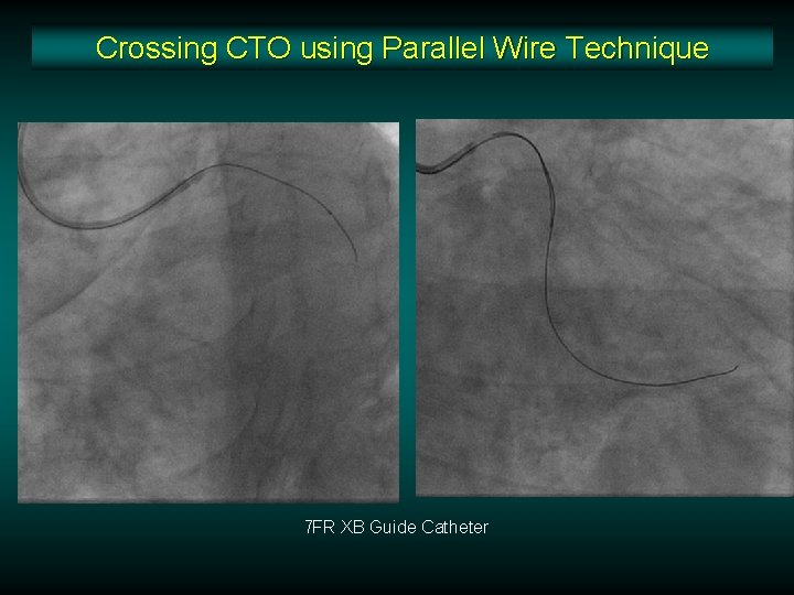 Crossing CTO using Parallel Wire Technique 7 FR XB Guide Catheter Crossing CTO using Parallel Wire Technique 7 FR XB Guide Catheter