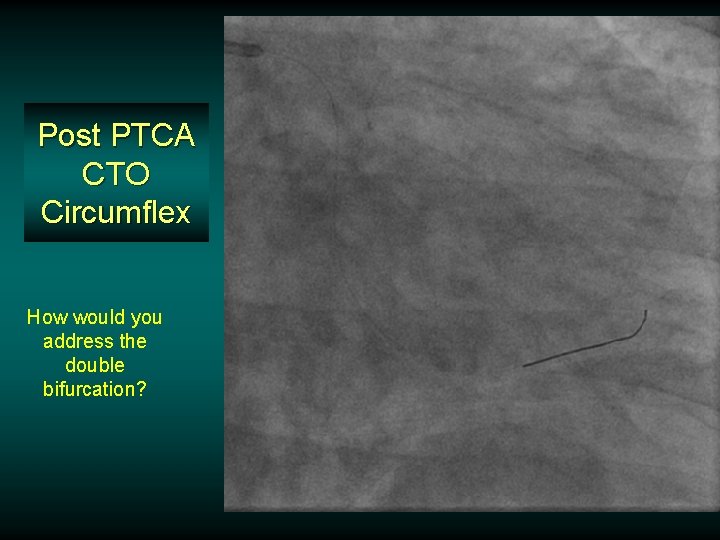 Post PTCA CTO Circumflex How would you address the double bifurcation? Post PTCA CTO Circumflex How would you address the double bifurcation?