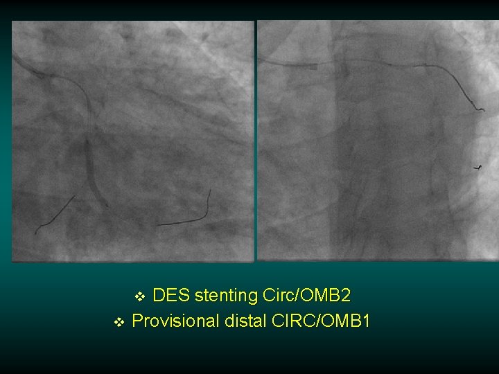 DES stenting Circ/OMB 2 Provisional distal CIRC/OMB 1 v v DES stenting Circ/OMB 2 Provisional distal CIRC/OMB 1 v v