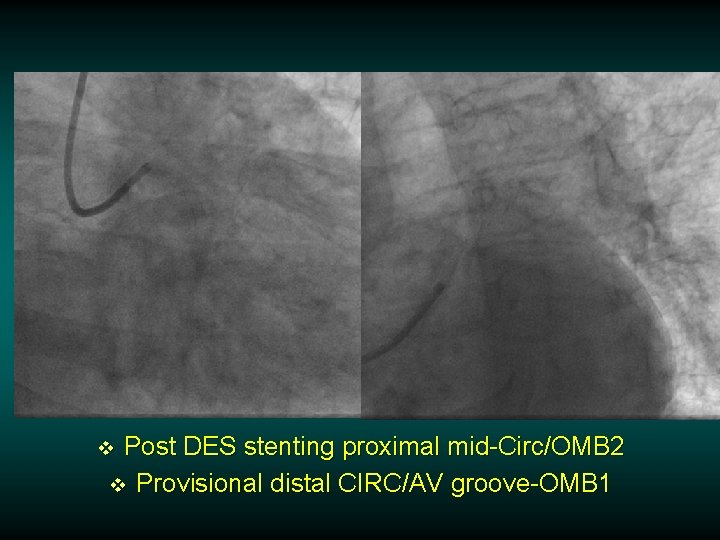 Post DES stenting proximal mid-Circ/OMB 2 v Provisional distal CIRC/AV groove-OMB 1 v Post DES stenting proximal mid-Circ/OMB 2 v Provisional distal CIRC/AV groove-OMB 1 v