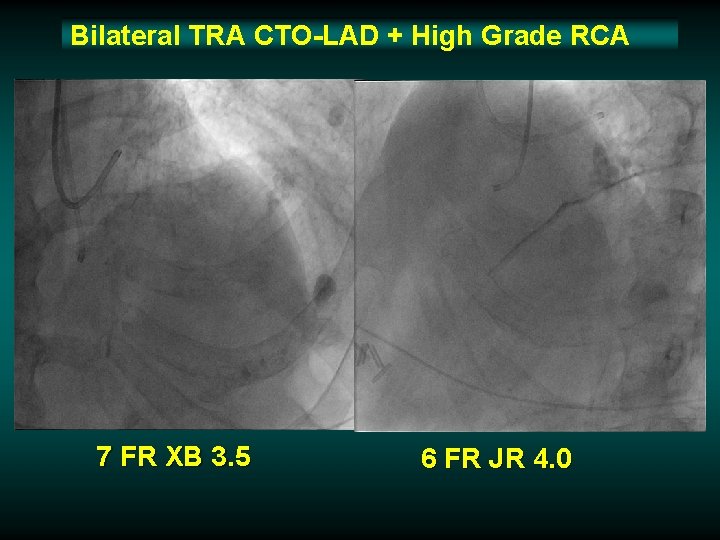 Bilateral TRA CTO-LAD + High Grade RCA 7 FR XB 3. 5 6 FR Bilateral TRA CTO-LAD + High Grade RCA 7 FR XB 3. 5 6 FR