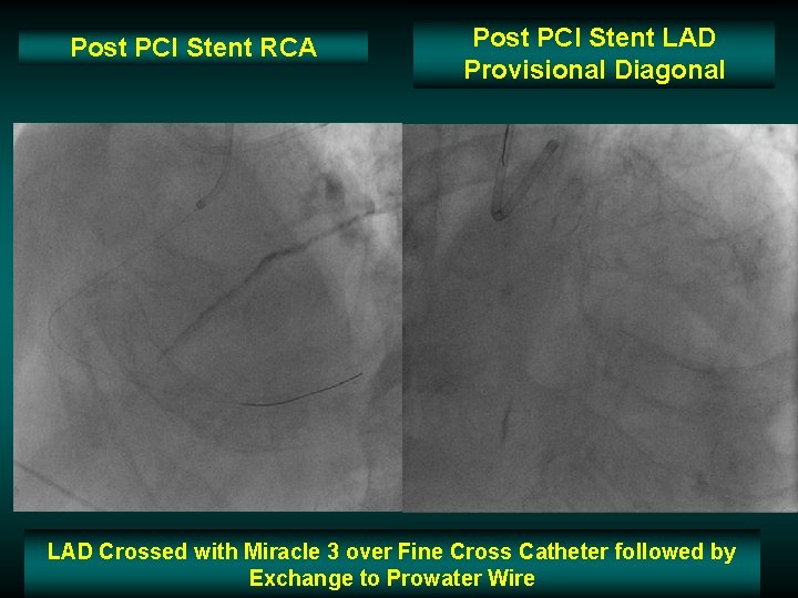 Post PCI Stent RCA Post PCI Stent LAD Provisional Diagonal LAD Crossed with Miracle Post PCI Stent RCA Post PCI Stent LAD Provisional Diagonal LAD Crossed with Miracle