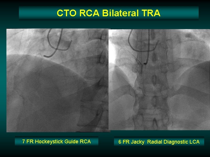 CTO RCA Bilateral TRA 7 FR Hockeystick Guide RCA 6 FR Jacky Radial Diagnostic CTO RCA Bilateral TRA 7 FR Hockeystick Guide RCA 6 FR Jacky Radial Diagnostic