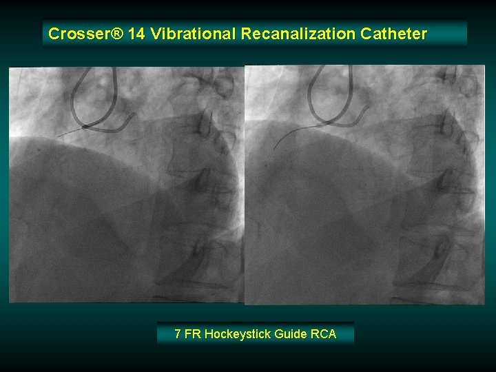 Crosser® 14 Vibrational Recanalization Catheter 7 FR Hockeystick Guide RCA Crosser® 14 Vibrational Recanalization Catheter 7 FR Hockeystick Guide RCA