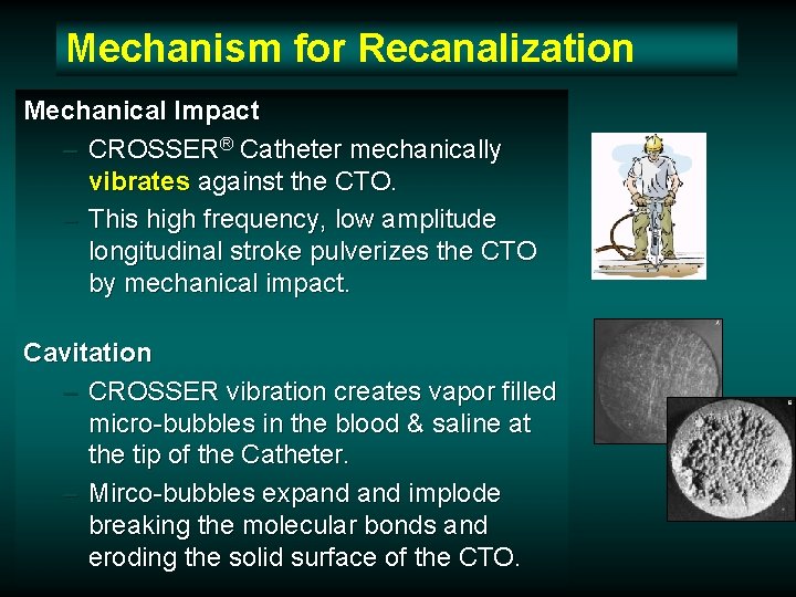 Mechanism for Recanalization Mechanical Impact – CROSSER® Catheter mechanically vibrates against the CTO. – Mechanism for Recanalization Mechanical Impact – CROSSER® Catheter mechanically vibrates against the CTO. –