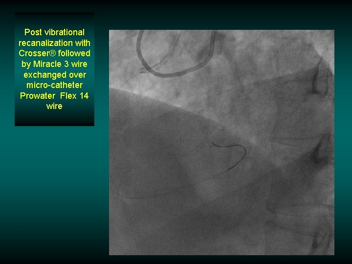 Post vibrational recanalization with Crosser® followed by Miracle 3 wire exchanged over micro-catheter Prowater Post vibrational recanalization with Crosser® followed by Miracle 3 wire exchanged over micro-catheter Prowater