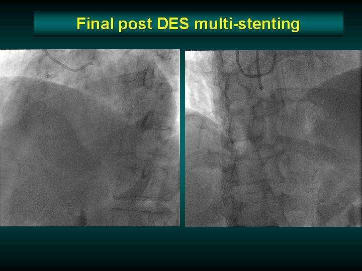 Final post DES multi-stenting Final post DES multi-stenting