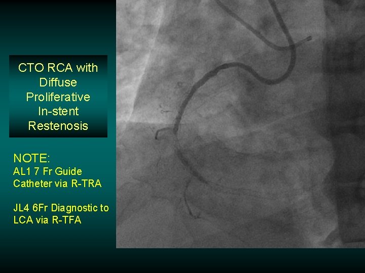 CTO RCA with Diffuse Proliferative In-stent Restenosis NOTE: AL 1 7 Fr Guide Catheter CTO RCA with Diffuse Proliferative In-stent Restenosis NOTE: AL 1 7 Fr Guide Catheter