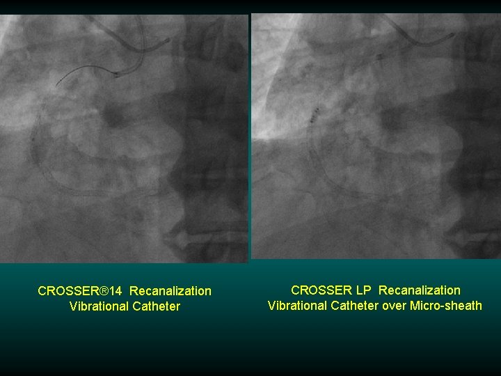 CROSSER® 14 Recanalization Vibrational Catheter CROSSER LP Recanalization Vibrational Catheter over Micro-sheath CROSSER® 14 Recanalization Vibrational Catheter CROSSER LP Recanalization Vibrational Catheter over Micro-sheath