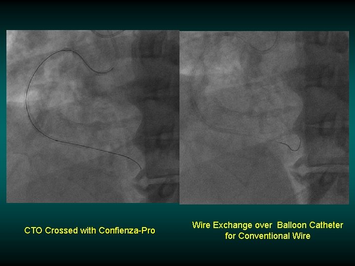 CTO Crossed with Confienza-Pro Wire Exchange over Balloon Catheter for Conventional Wire CTO Crossed with Confienza-Pro Wire Exchange over Balloon Catheter for Conventional Wire