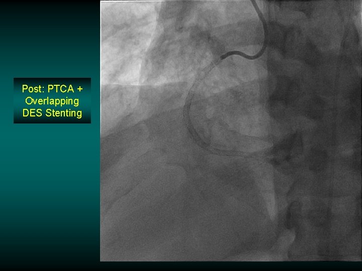 Post: PTCA + Overlapping DES Stenting Post: PTCA + Overlapping DES Stenting