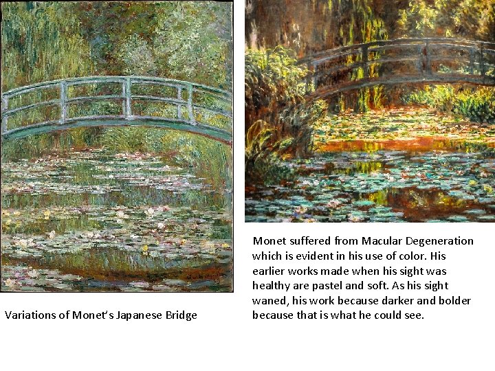 Variations of Monet’s Japanese Bridge Monet suffered from Macular Degeneration which is evident in