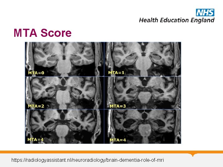 MTA Score https: //radiologyassistant. nl/neuroradiology/brain-dementia-role-of-mri MTA Score https: //radiologyassistant. nl/neuroradiology/brain-dementia-role-of-mri