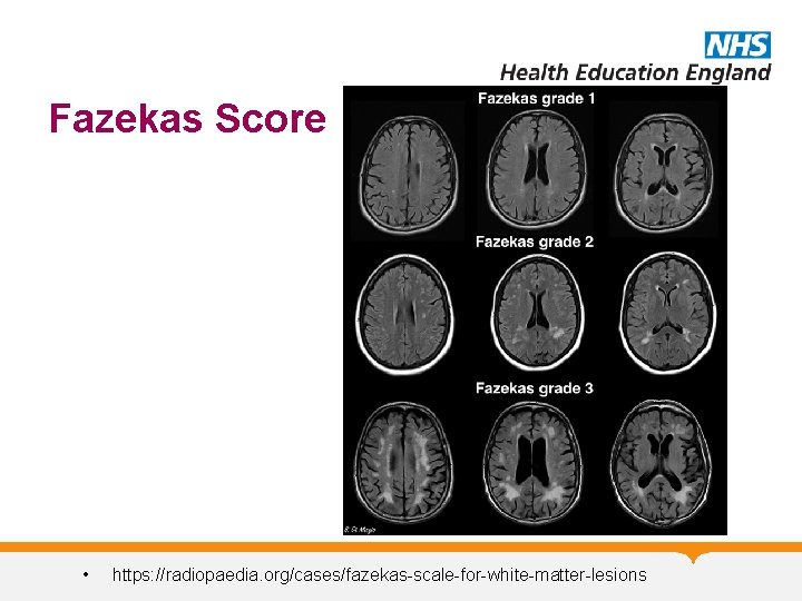 Fazekas Score • https: //radiopaedia. org/cases/fazekas-scale-for-white-matter-lesions Fazekas Score • https: //radiopaedia. org/cases/fazekas-scale-for-white-matter-lesions
