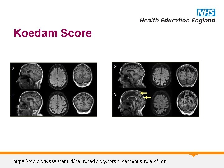 Koedam Score https: //radiologyassistant. nl/neuroradiology/brain-dementia-role-of-mri Koedam Score https: //radiologyassistant. nl/neuroradiology/brain-dementia-role-of-mri