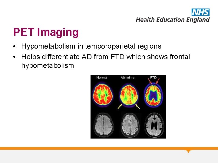 PET Imaging • Hypometabolism in temporoparietal regions • Helps differentiate AD from FTD which PET Imaging • Hypometabolism in temporoparietal regions • Helps differentiate AD from FTD which