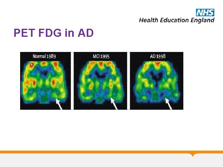 PET FDG in AD PET FDG in AD