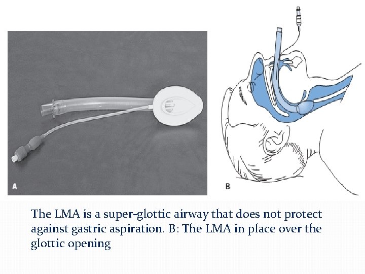 The LMA is a super-glottic airway that does not protect against gastric aspiration. B: