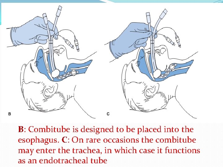 B: Combitube is designed to be placed into the esophagus. C: On rare occasions