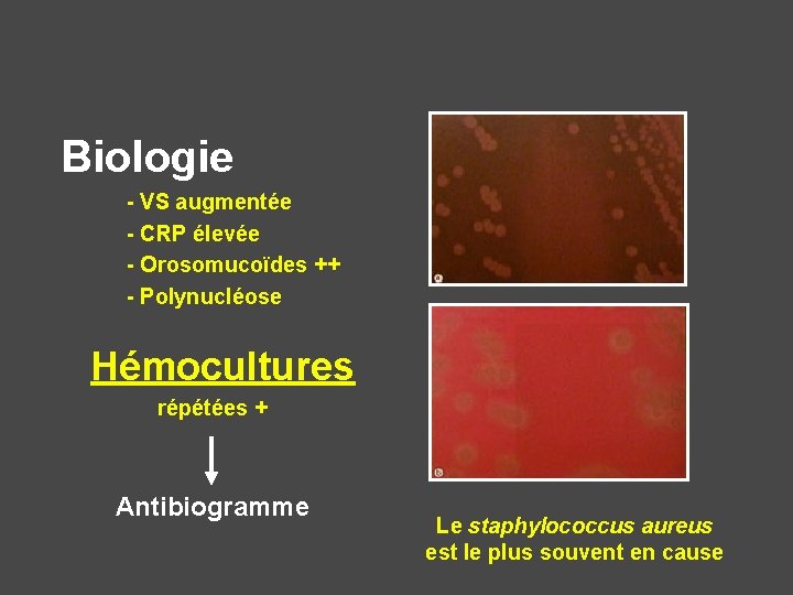 Biologie - VS augmentée - CRP élevée - Orosomucoïdes ++ - Polynucléose Hémocultures répétées