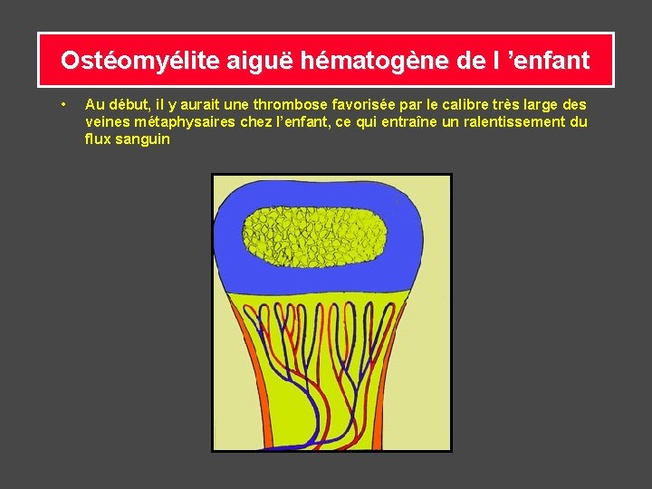 Ostéomyélite aiguë hématogène de l ’enfant • Au début, il y aurait une thrombose