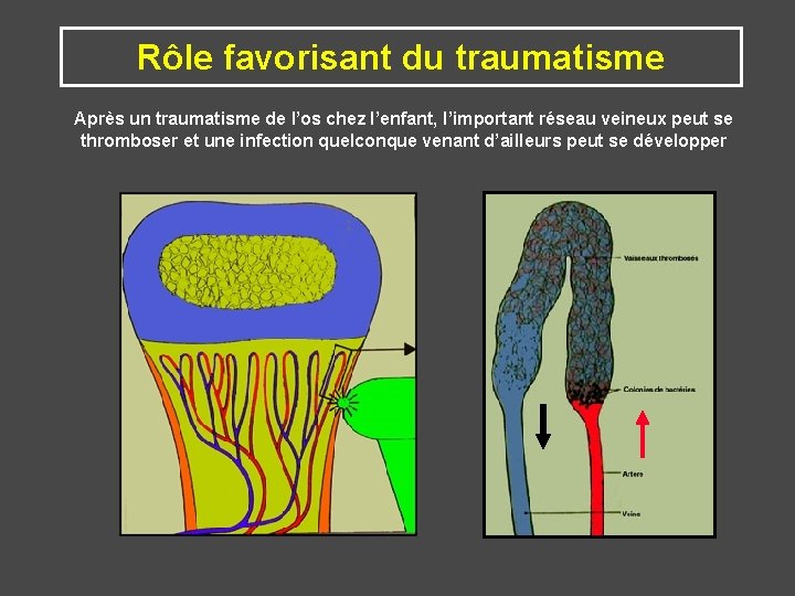 Rôle favorisant du traumatisme Après un traumatisme de l’os chez l’enfant, l’important réseau veineux