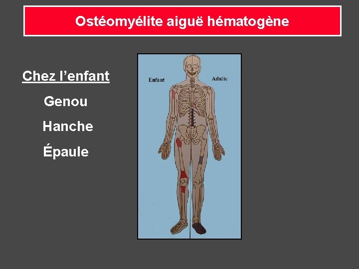 Ostéomyélite aiguë hématogène Chez l’enfant Genou Hanche Épaule 