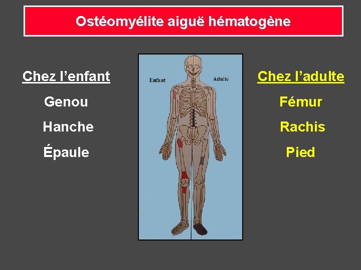 Ostéomyélite aiguë hématogène Chez l’enfant Chez l’adulte Genou Fémur Hanche Rachis Épaule Pied 