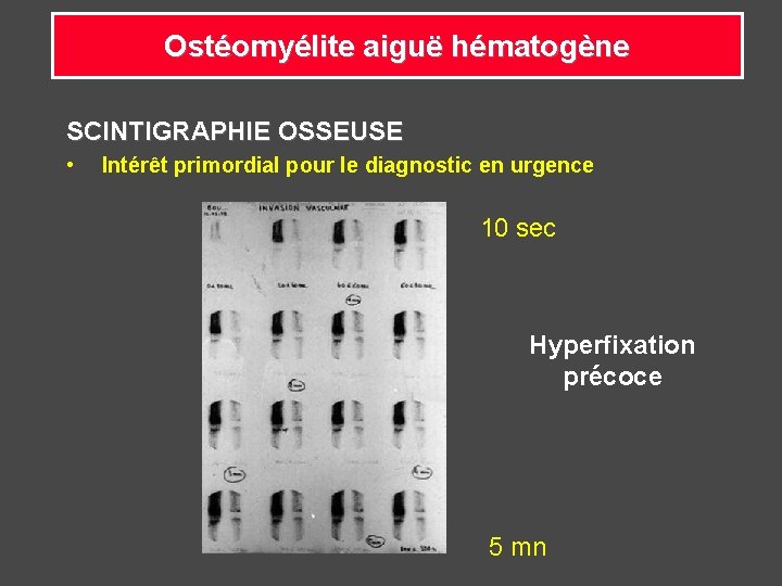 Ostéomyélite aiguë hématogène SCINTIGRAPHIE OSSEUSE • Intérêt primordial pour le diagnostic en urgence 10