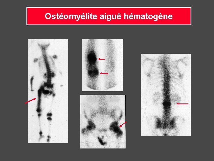 Ostéomyélite aiguë hématogène 