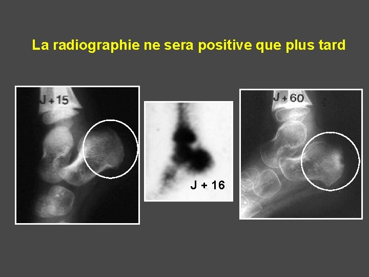 La radiographie ne sera positive que plus tard J + 16 