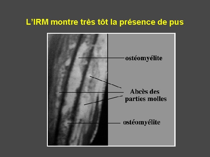 L’IRM montre très tôt la présence de pus 