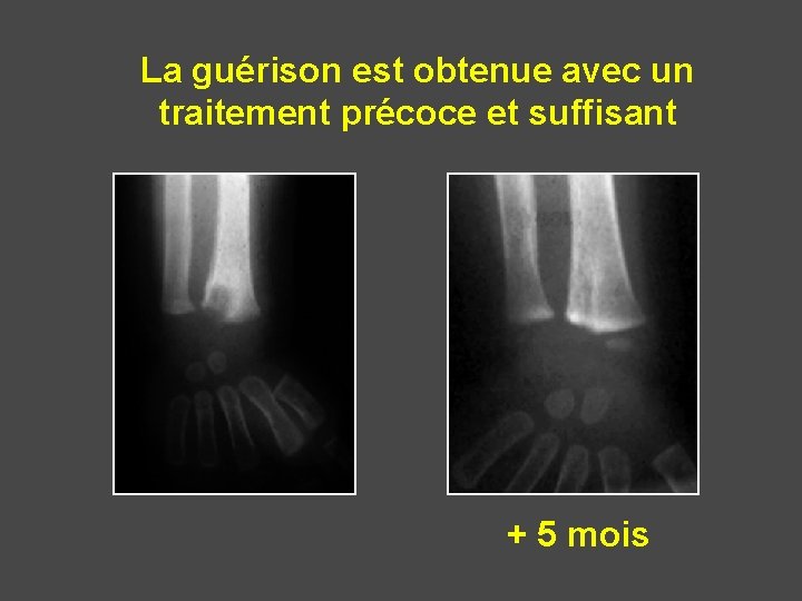 La guérison est obtenue avec un traitement précoce et suffisant + 5 mois 