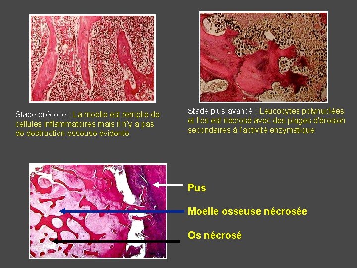 Stade précoce : La moelle est remplie de cellules inflammatoires mais il n’y a