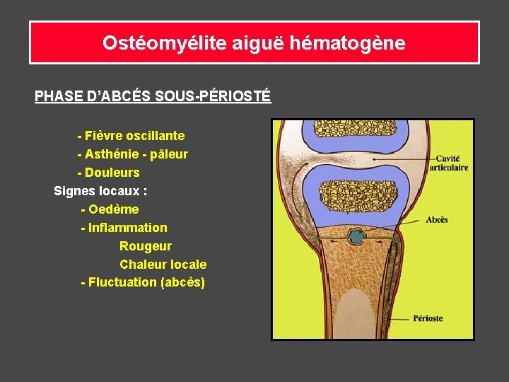 Ostéomyélite aiguë hématogène PHASE D’ABCÉS SOUS-PÉRIOSTÉ - Fièvre oscillante - Asthénie - pâleur -