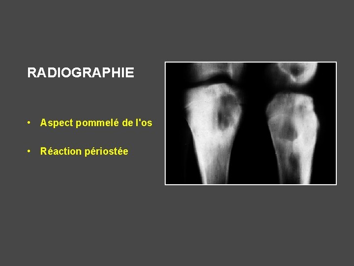 RADIOGRAPHIE • Aspect pommelé de l'os • Réaction périostée 