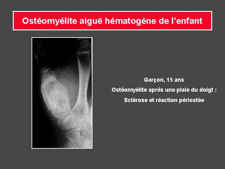 Ostéomyélite aiguë hématogène de l’enfant Garçon, 15 ans Ostéomyélite après une plaie du doigt