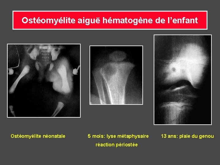 Ostéomyélite aiguë hématogène de l’enfant Ostéomyélite néonatale 5 mois: lyse métaphysaire 13 ans: plaie