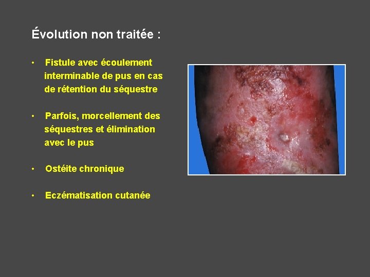 Évolution non traitée : • Fistule avec écoulement interminable de pus en cas de