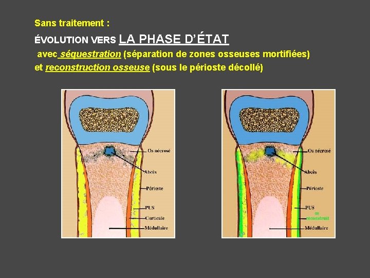 Sans traitement : ÉVOLUTION VERS LA PHASE D’ÉTAT avec séquestration (séparation de zones osseuses