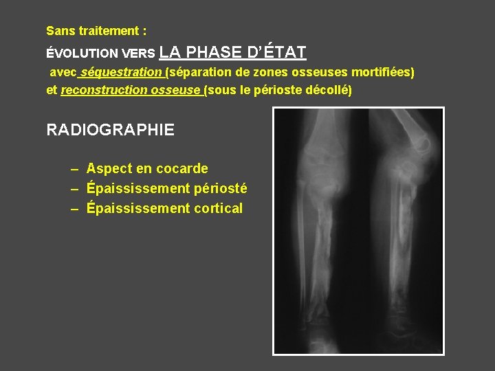 Sans traitement : ÉVOLUTION VERS LA PHASE D’ÉTAT avec séquestration (séparation de zones osseuses