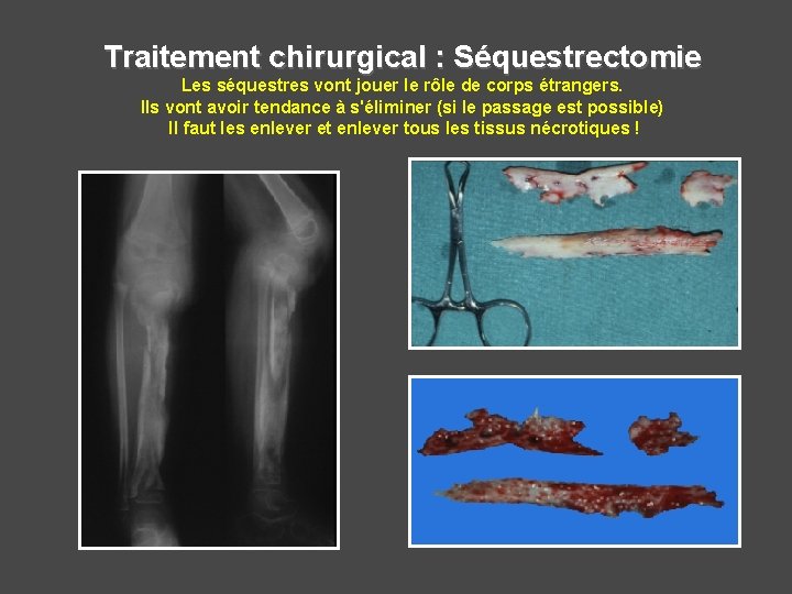 Traitement chirurgical : Séquestrectomie Les séquestres vont jouer le rôle de corps étrangers. Ils