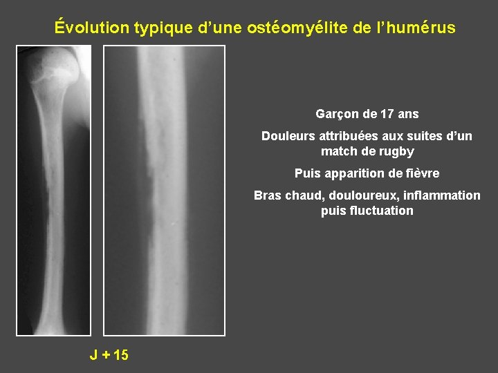 Évolution typique d’une ostéomyélite de l’humérus Garçon de 17 ans Douleurs attribuées aux suites