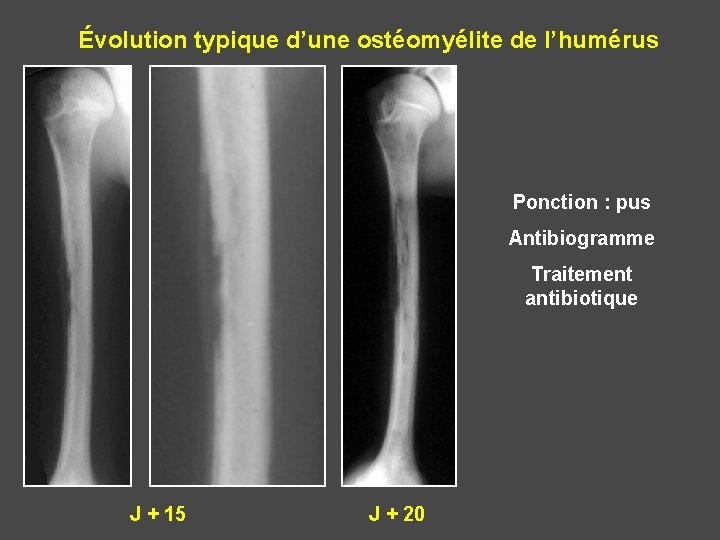 Évolution typique d’une ostéomyélite de l’humérus Ponction : pus Antibiogramme Traitement antibiotique J +