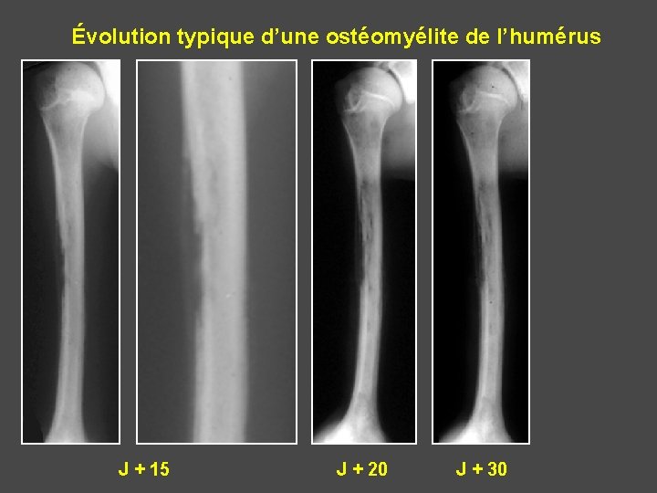 Évolution typique d’une ostéomyélite de l’humérus J + 15 J + 20 J +