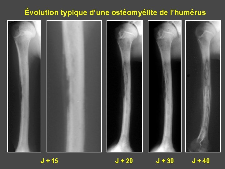 Évolution typique d’une ostéomyélite de l’humérus J + 15 J + 20 J +