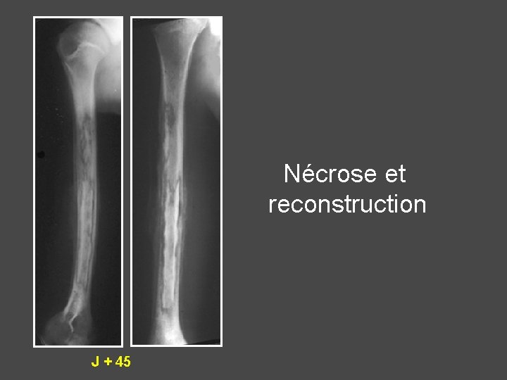 Nécrose et reconstruction J + 45 