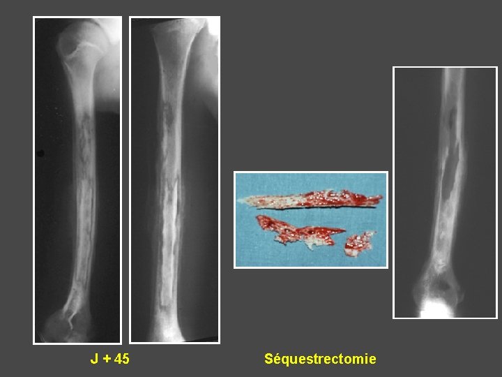 J + 45 Séquestrectomie 